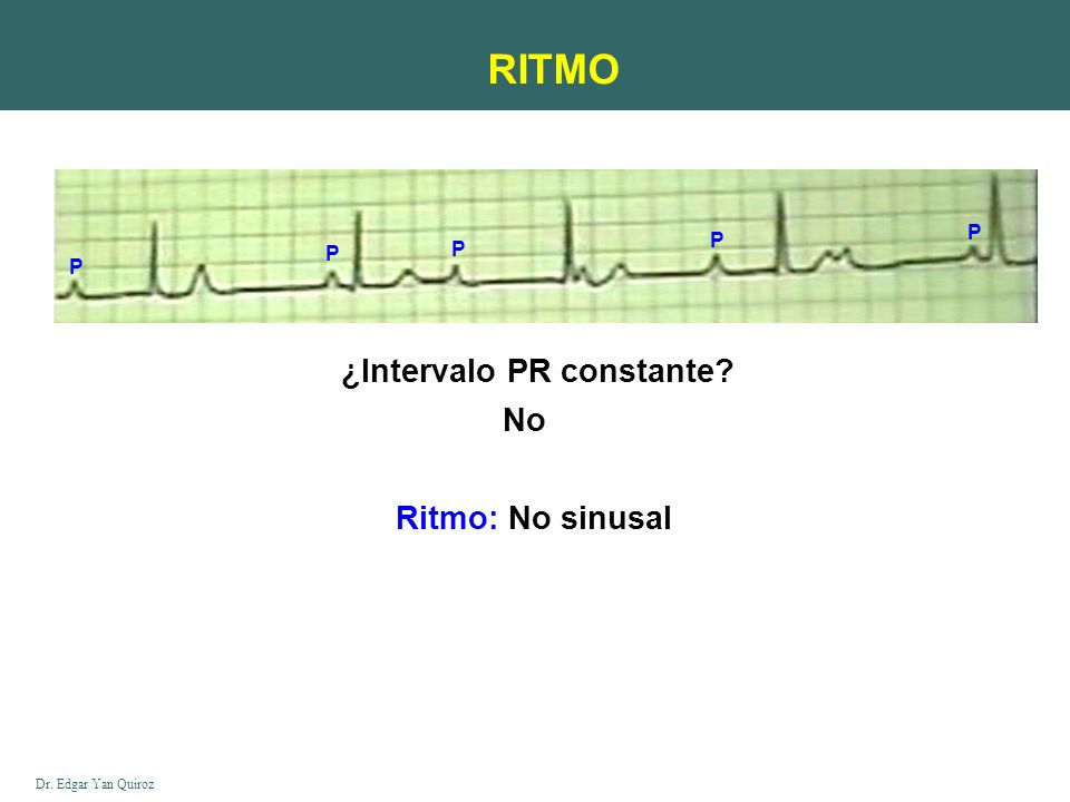 RITMO P P P P P ¿Intervalo PR constante No Ritmo: No sinusal