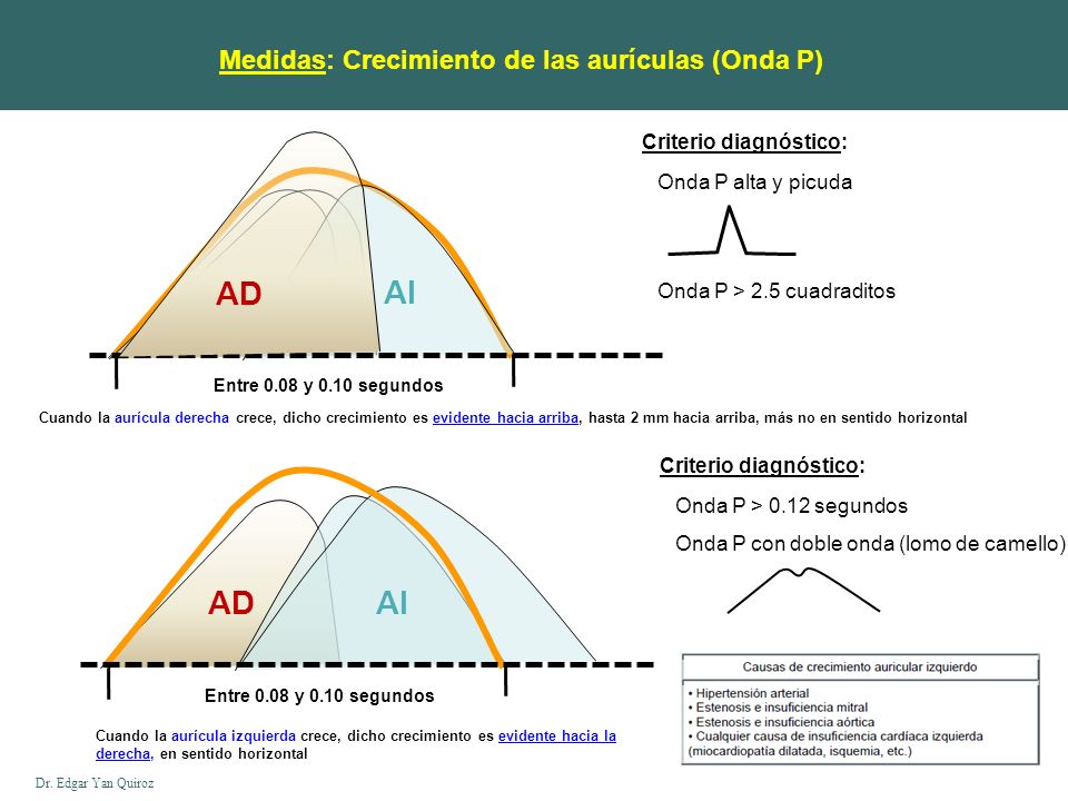 AD AI AD AI Medidas: Crecimiento de las aurículas (Onda P)
