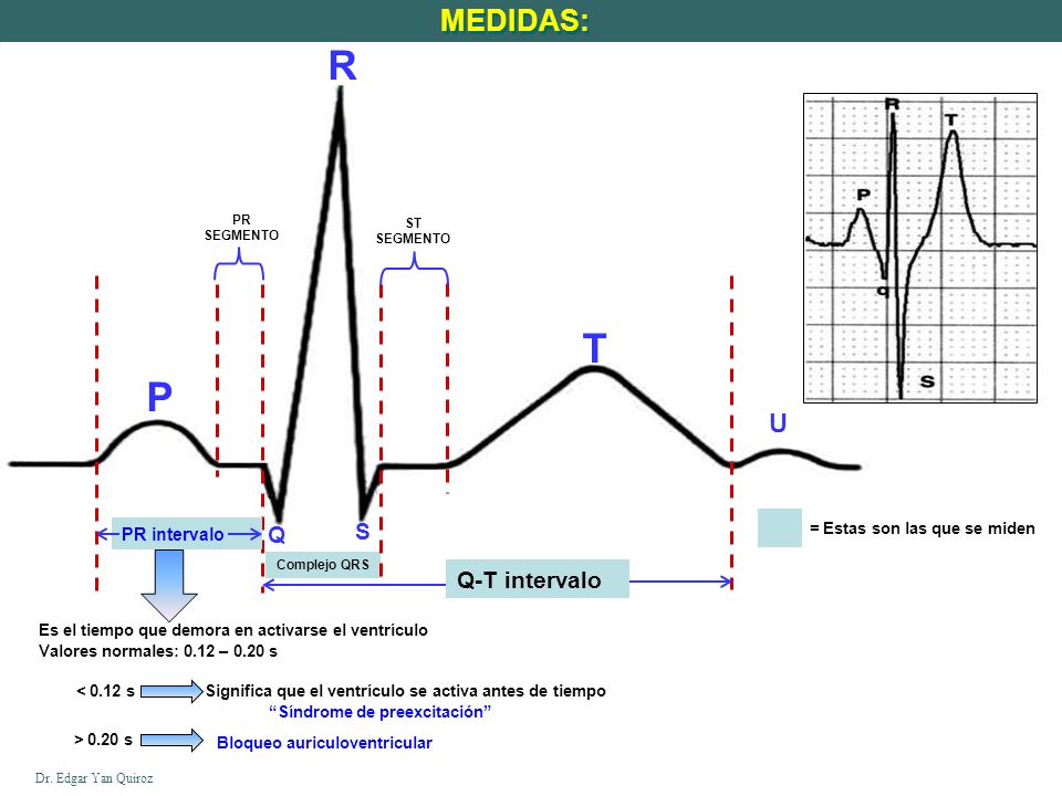 R T P MEDIDAS: U S Q Q-T intervalo PR intervalo