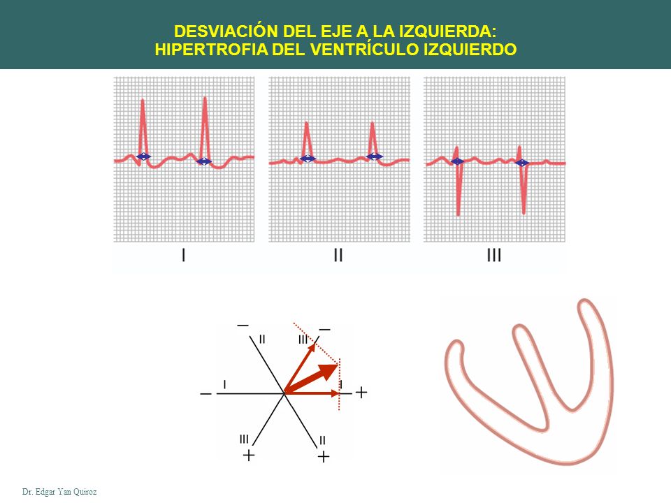 DESVIACIÓN DEL EJE A LA IZQUIERDA: HIPERTROFIA DEL VENTRÍCULO IZQUIERDO