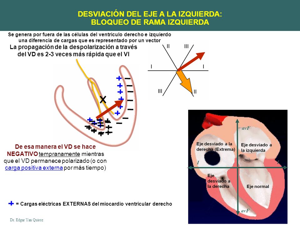 DESVIACIÓN DEL EJE A LA IZQUIERDA: BLOQUEO DE RAMA IZQUIERDA