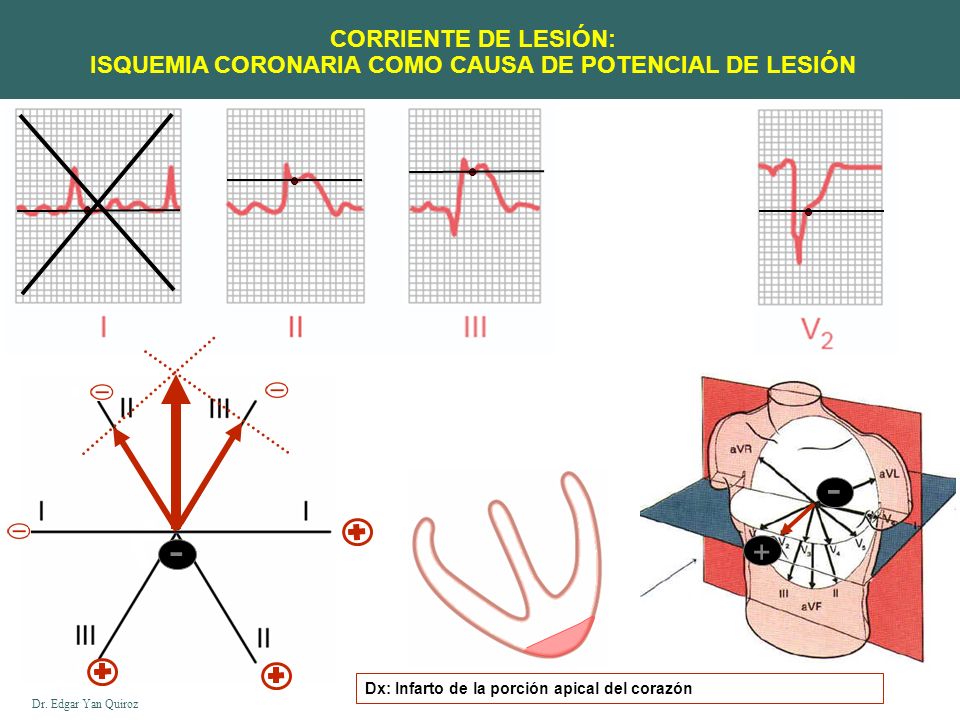 CORRIENTE DE LESIÓN: ISQUEMIA CORONARIA COMO CAUSA DE POTENCIAL DE LESIÓN