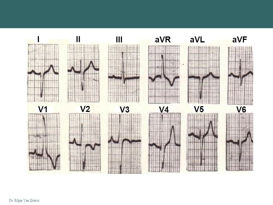 I II III aVR aVL aVF V1 V2 V3 V4 V5 V6