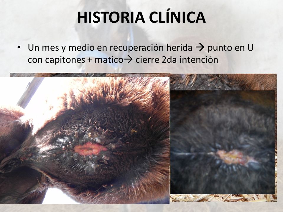 HISTORIA CLÍNICA Un mes y medio en recuperación herida  punto en U con capitones + matico cierre 2da intención.