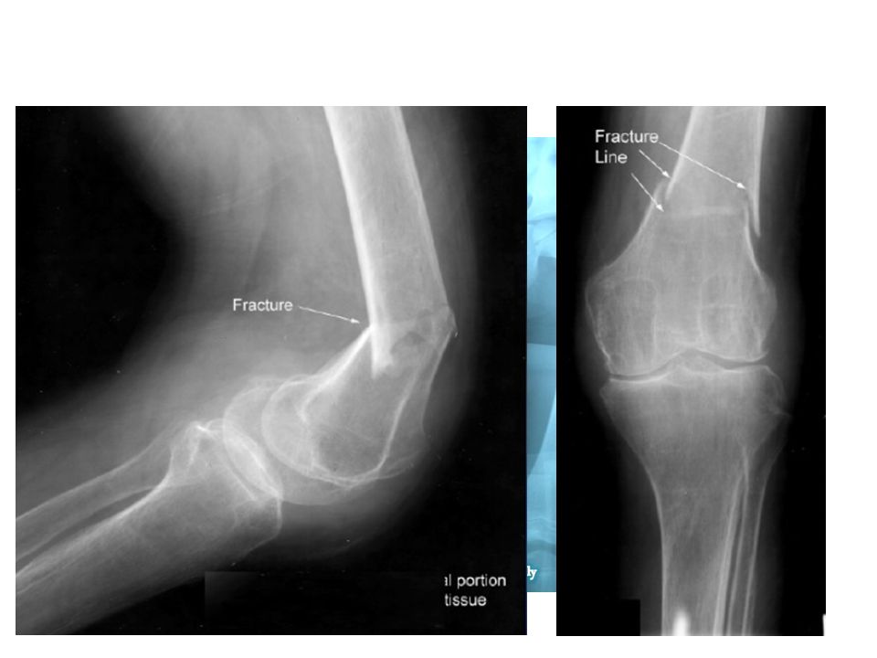 The initial evaluation of a trauma patient with a femur fracture should include radiographs of the chest, AP pelvis, hip, and knee. If any concern for a femoral neck or acetabular fracture exists, a CT should be performed to rule these out.