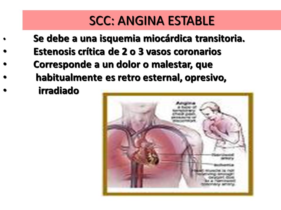 SCC: ANGINA ESTABLE Estenosis crítica de 2 o 3 vasos coronarios