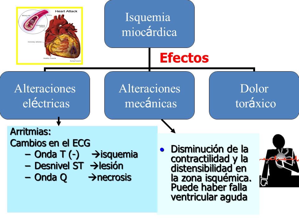 Efectos Arritmias: Cambios en el ECG. Onda T (-) isquemia. Desnivel ST lesión. Onda Q necrosis.