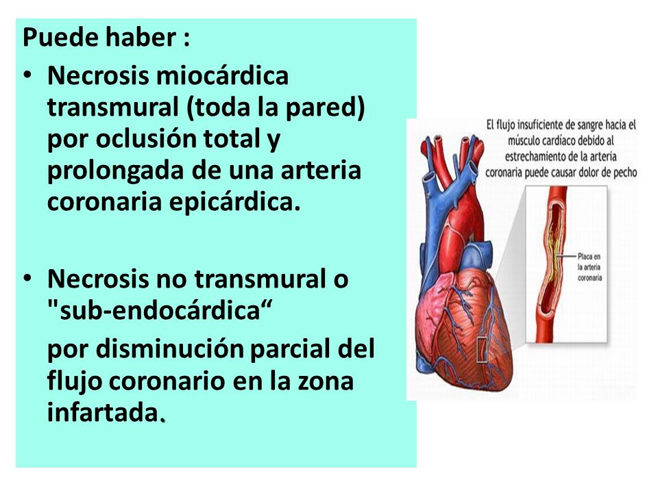 Puede haber : Necrosis miocárdica transmural (toda la pared) por oclusión total y prolongada de una arteria coronaria epicárdica.