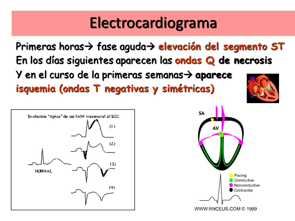 Electrocardiograma Primeras horas fase aguda elevación del segmento ST. En los días siguientes aparecen las ondas Q de necrosis.