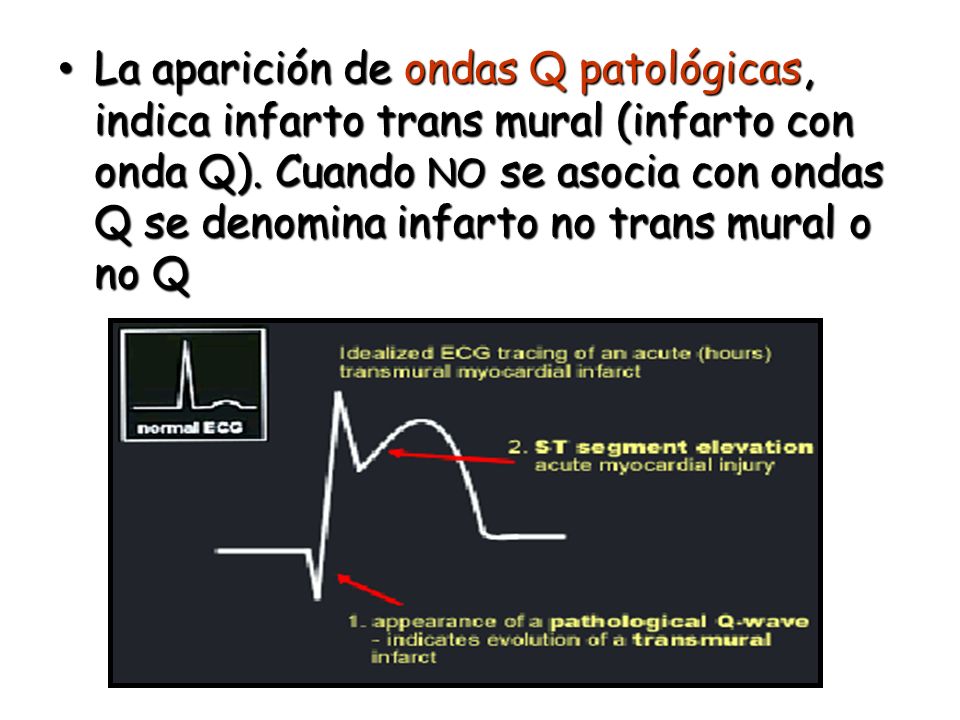 La aparición de ondas Q patológicas, indica infarto trans mural (infarto con onda Q).