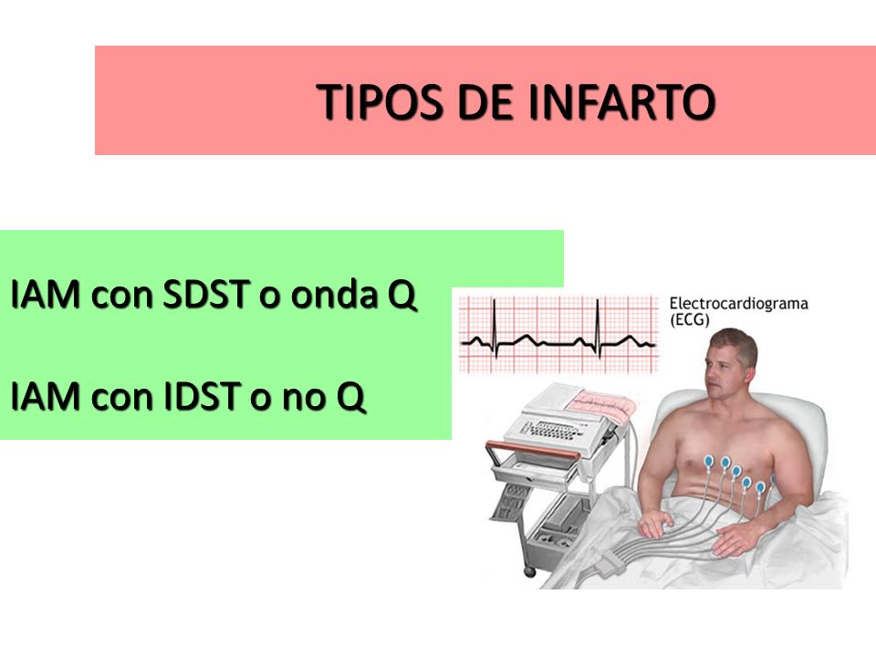 TIPOS DE INFARTO IAM con SDST o onda Q IAM con IDST o no Q