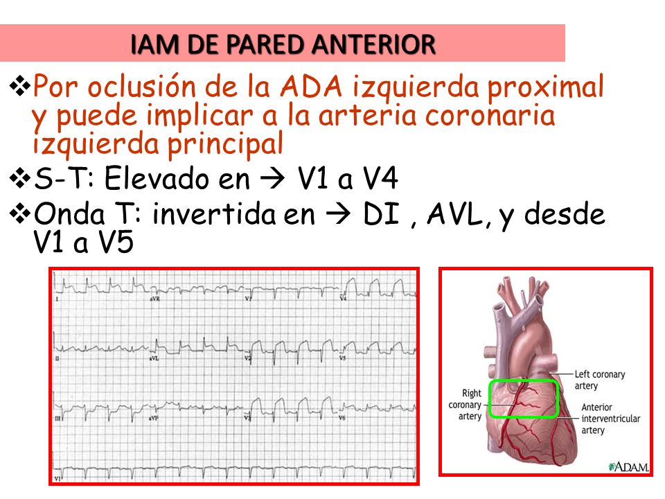 IAM DE PARED ANTERIOR Por oclusión de la ADA izquierda proximal y puede implicar a la arteria coronaria izquierda principal.