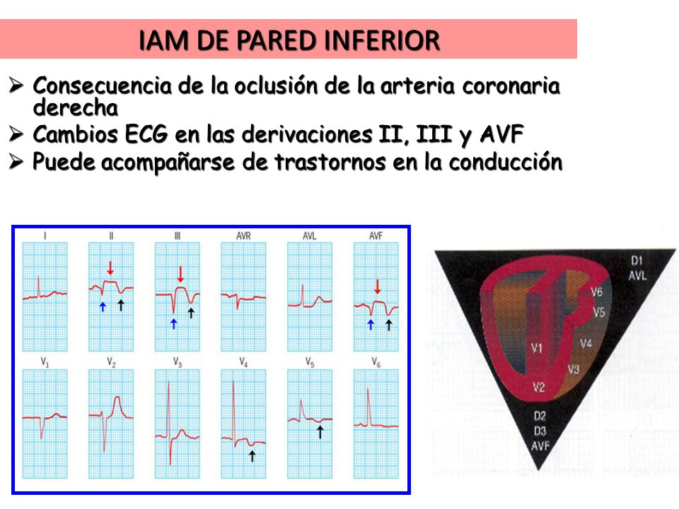 IAM DE PARED INFERIOR Consecuencia de la oclusión de la arteria coronaria derecha. Cambios ECG en las derivaciones II, III y AVF.