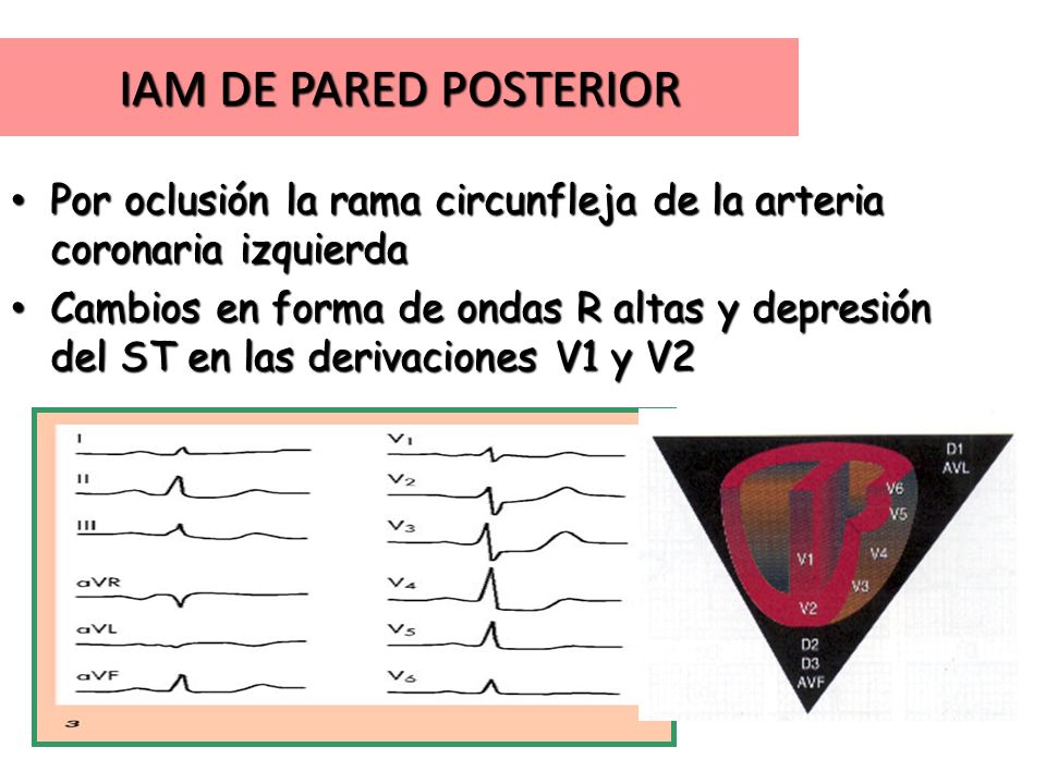 IAM DE PARED POSTERIOR Por oclusión la rama circunfleja de la arteria coronaria izquierda.