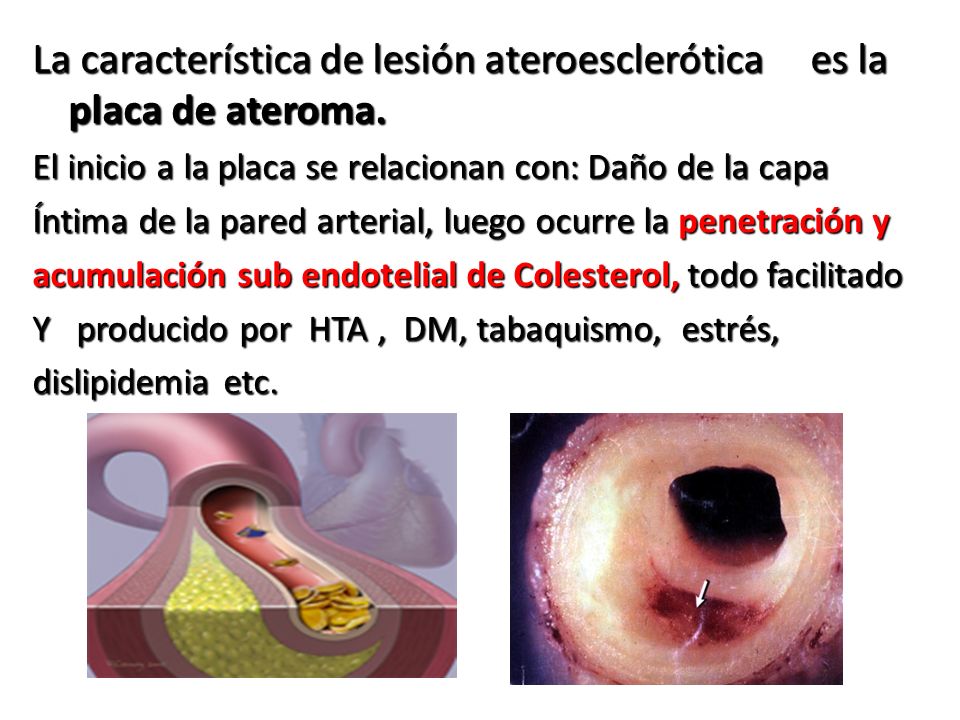 La característica de lesión ateroesclerótica es la placa de ateroma.