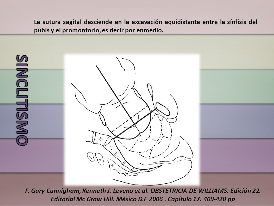 La sutura sagital desciende en la excavación equidistante entre la sínfisis del pubis y el promontorio, es decir por enmedio.