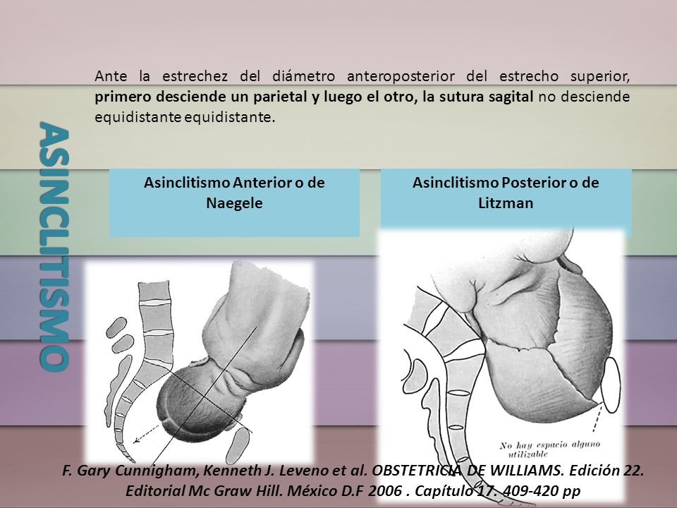 Asinclitismo Anterior o de Naegele Asinclitismo Posterior o de Litzman