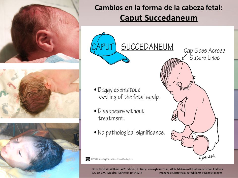 Cambios en la forma de la cabeza fetal: Caput Succedaneum