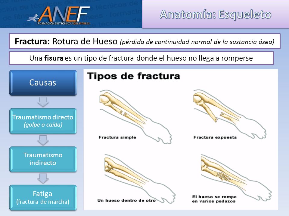 Anatomía: Esqueleto Fractura: Rotura de Hueso (pérdida de continuidad normal de la sustancia ósea)