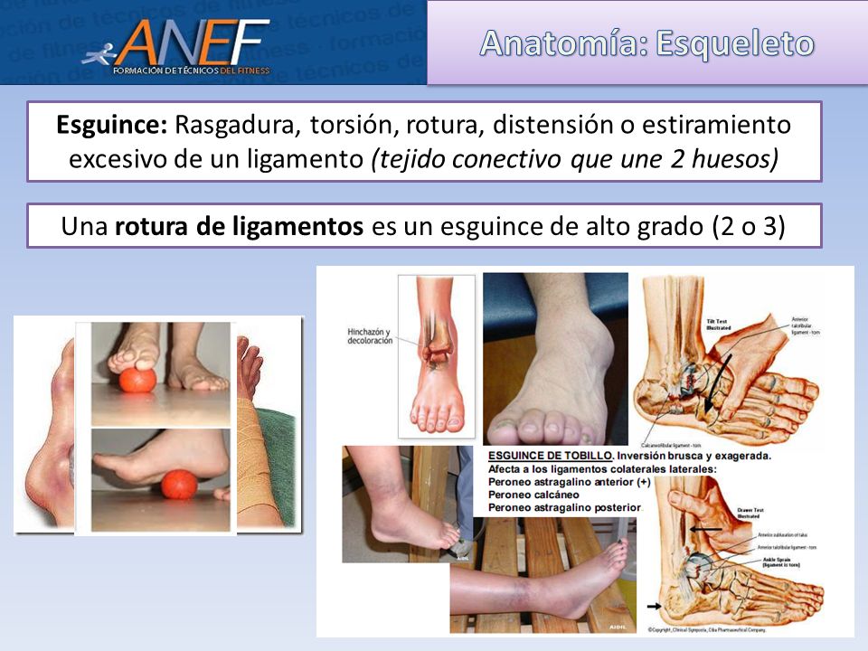 Una rotura de ligamentos es un esguince de alto grado (2 o 3)