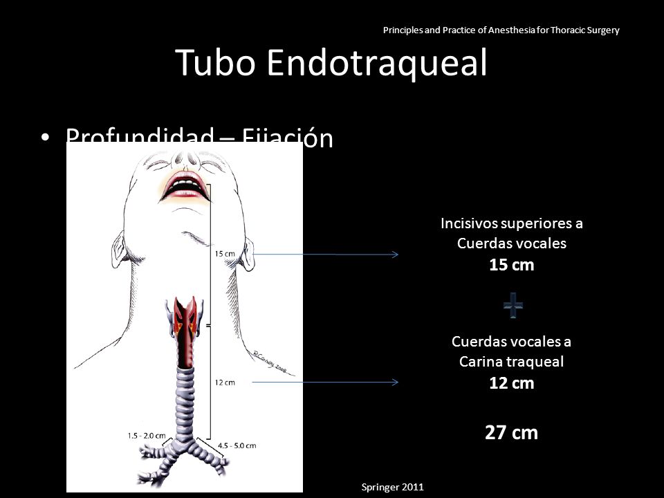 Tubo Endotraqueal Profundidad – Fijación 27 cm 15 cm 12 cm