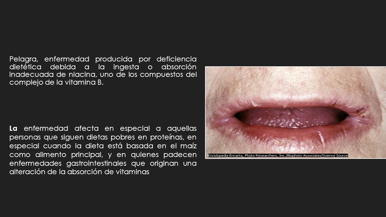 Pelagra, enfermedad producida por deficiencia dietética debida a la ingesta o absorción inadecuada de niacina, uno de los compuestos del complejo de la vitamina B.