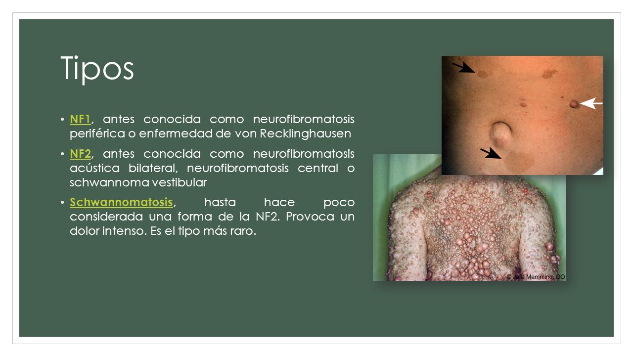 Tipos NF1, antes conocida como neurofibromatosis periférica o enfermedad de von Recklinghausen.