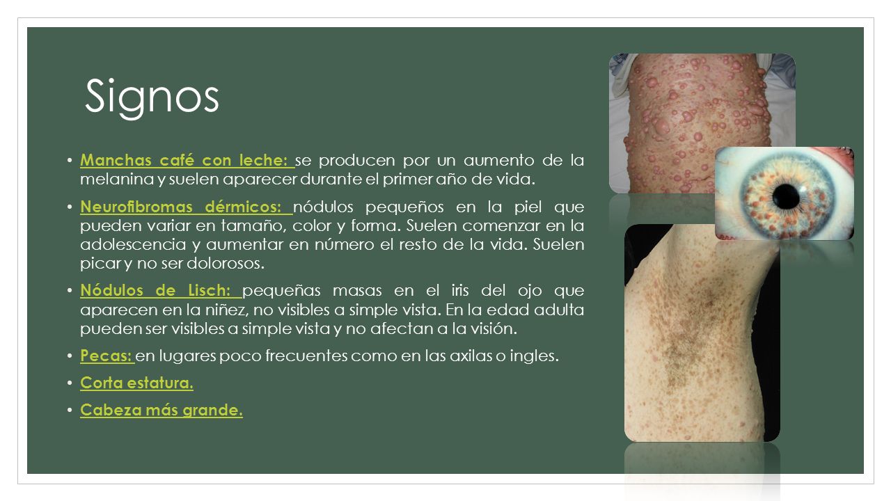 Signos Manchas café con leche: se producen por un aumento de la melanina y suelen aparecer durante el primer año de vida.