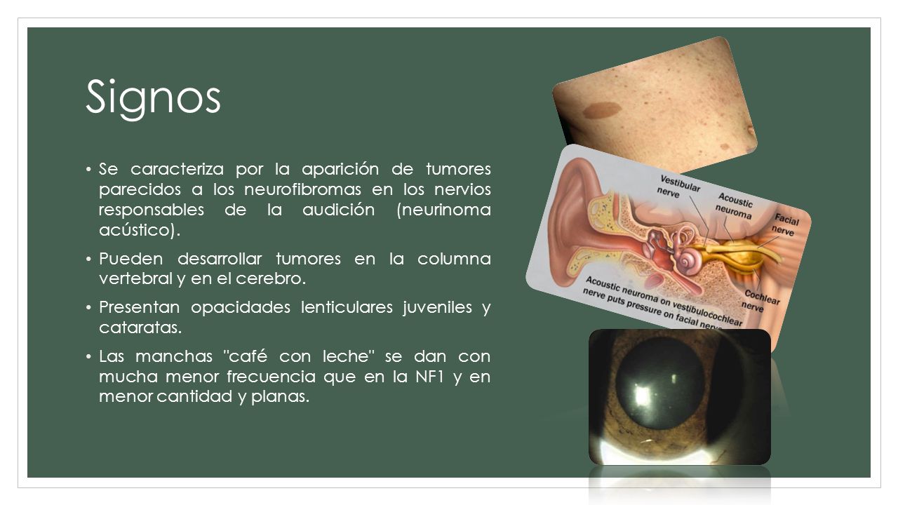 Signos Se caracteriza por la aparición de tumores parecidos a los neurofibromas en los nervios responsables de la audición (neurinoma acústico).