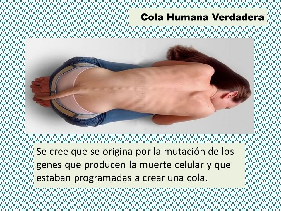 Cola Humana Verdadera Se cree que se origina por la mutación de los genes que producen la muerte celular y que estaban programadas a crear una cola.