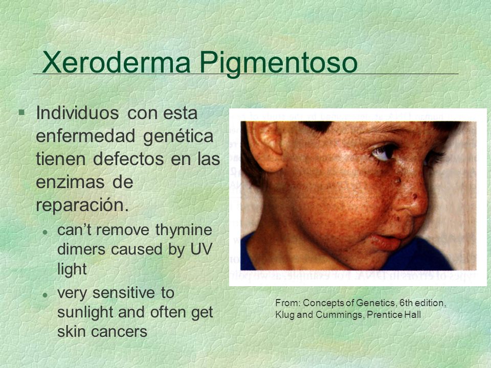Xeroderma Pigmentoso Individuos con esta enfermedad genética tienen defectos en las enzimas de reparación.