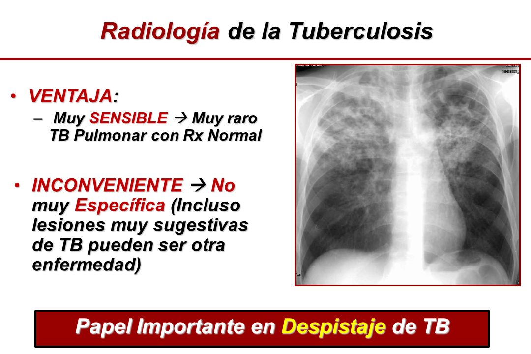 Radiología de la Tuberculosis Papel Importante en Despistaje de TB