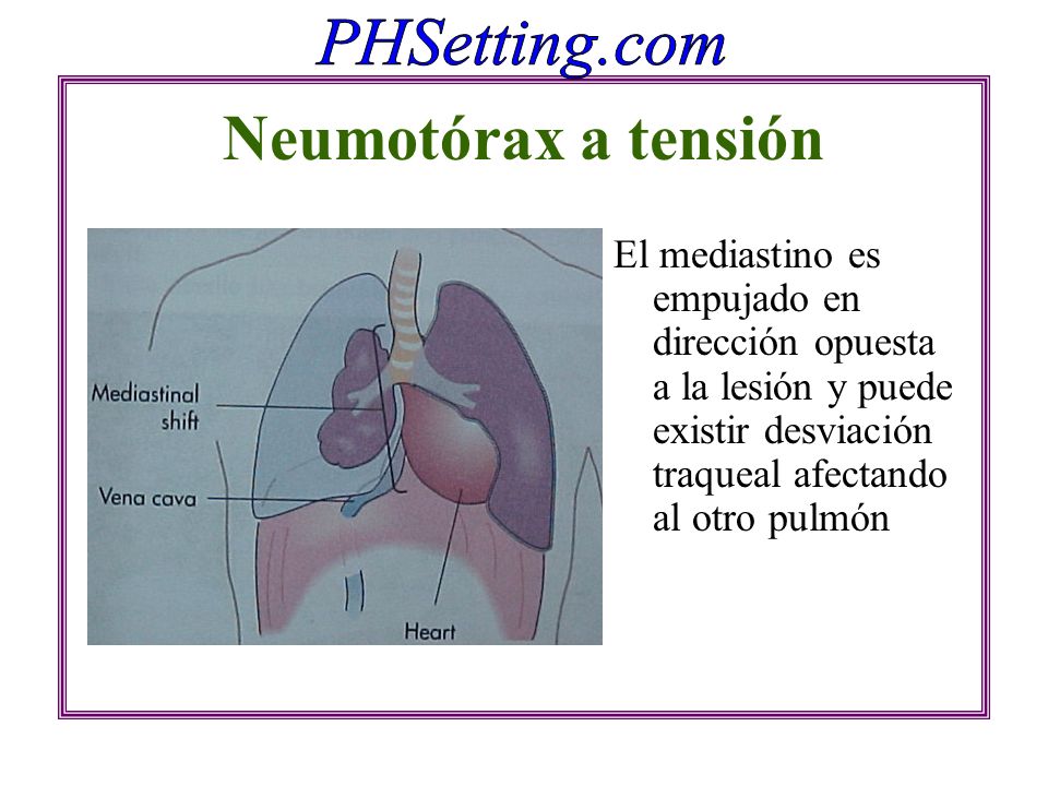Neumotórax a tensión El mediastino es empujado en dirección opuesta a la lesión y puede existir desviación traqueal afectando al otro pulmón.