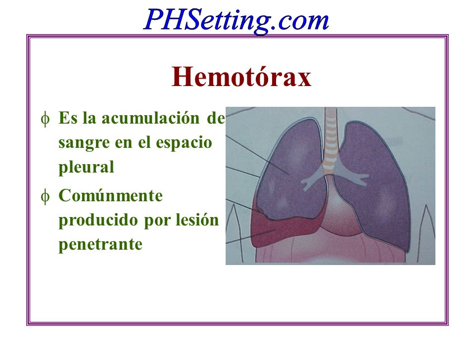 Hemotórax Es la acumulación de sangre en el espacio pleural