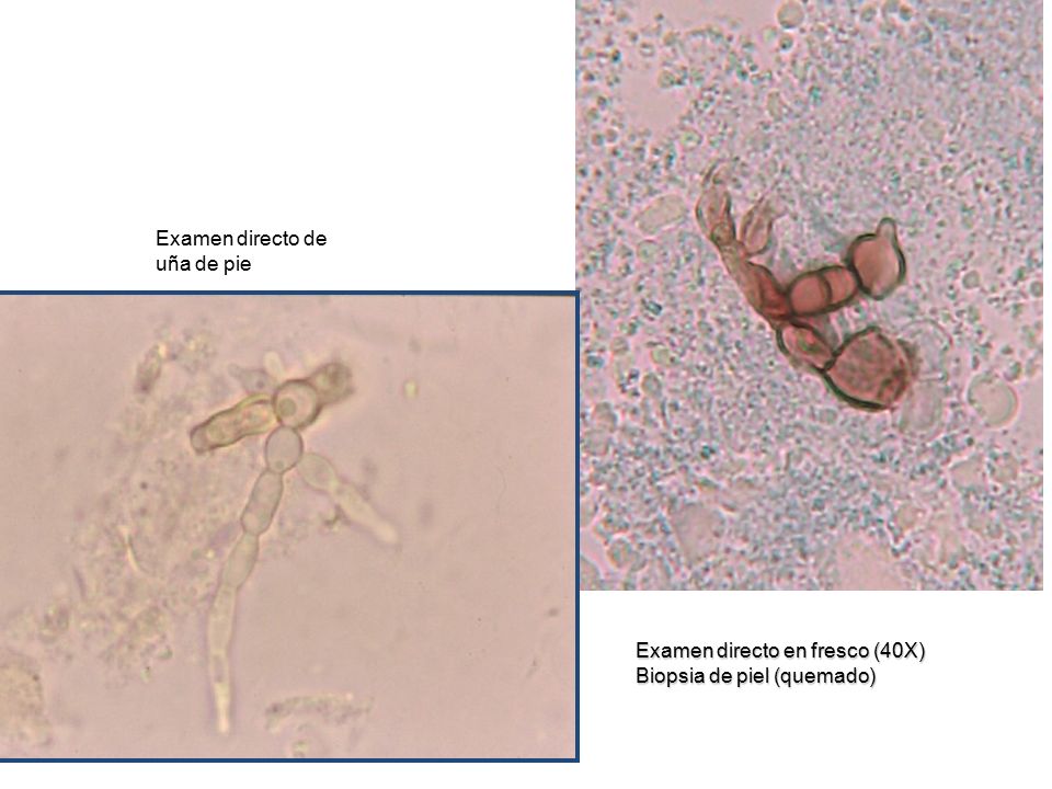 Examen directo de uña de pie Examen directo en fresco (40X) Biopsia de piel (quemado)