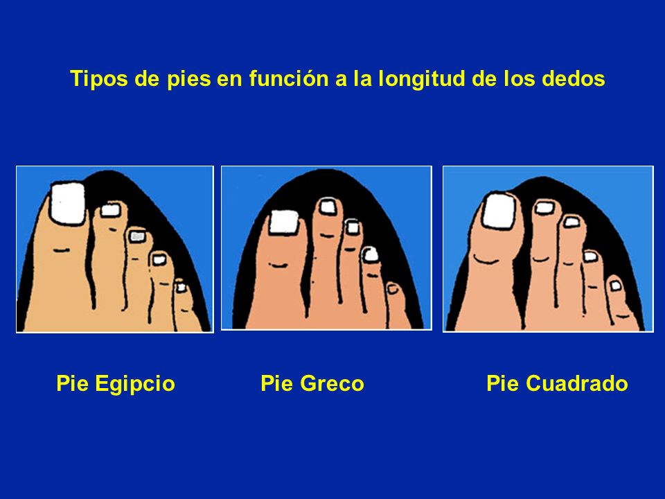 Tipos de pies en función a la longitud de los dedos