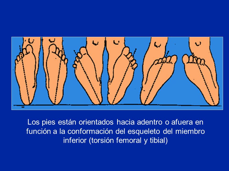 Los pies están orientados hacia adentro o afuera en función a la conformación del esqueleto del miembro inferior (torsión femoral y tibial)