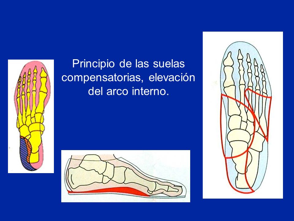 Principio de las suelas compensatorias, elevación del arco interno.