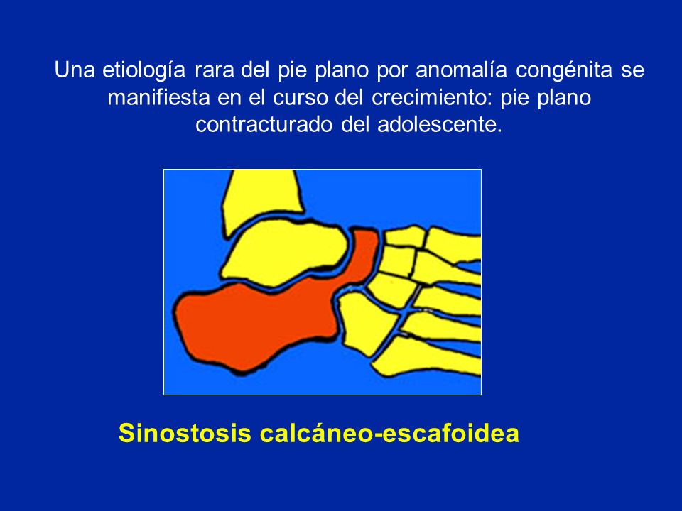 Sinostosis calcáneo-escafoidea