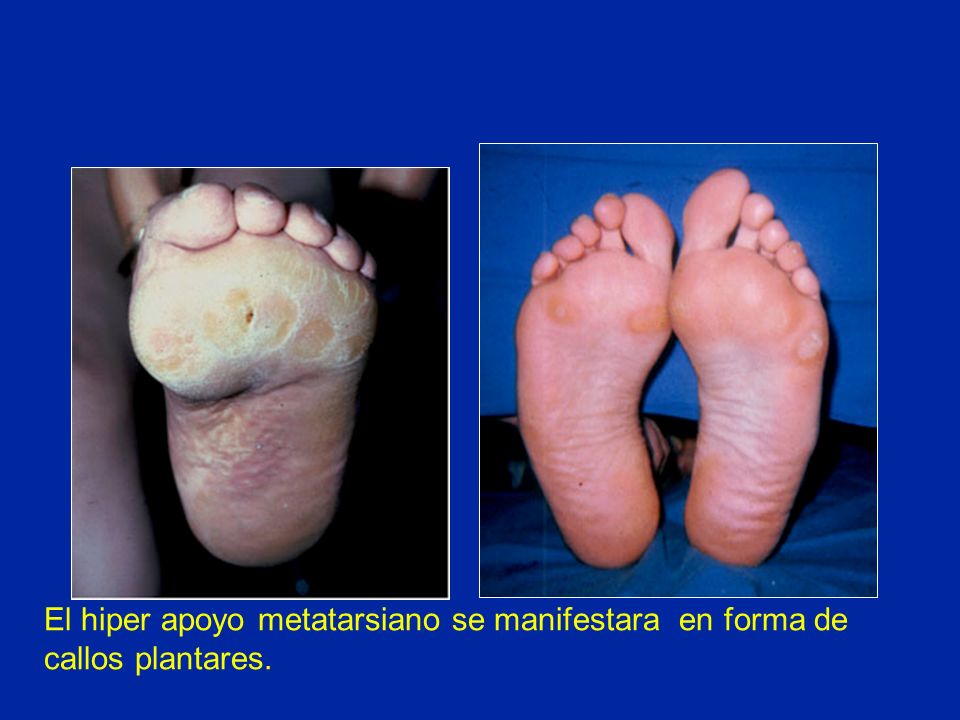 El hiper apoyo metatarsiano se manifestara en forma de callos plantares.
