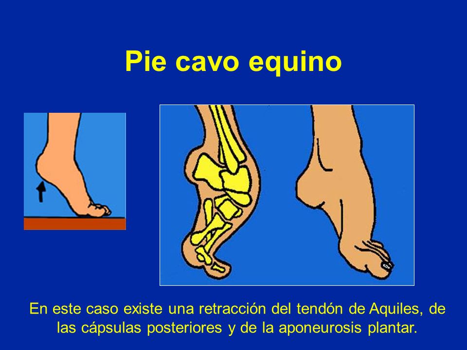Pie cavo equino En este caso existe una retracción del tendón de Aquiles, de las cápsulas posteriores y de la aponeurosis plantar.