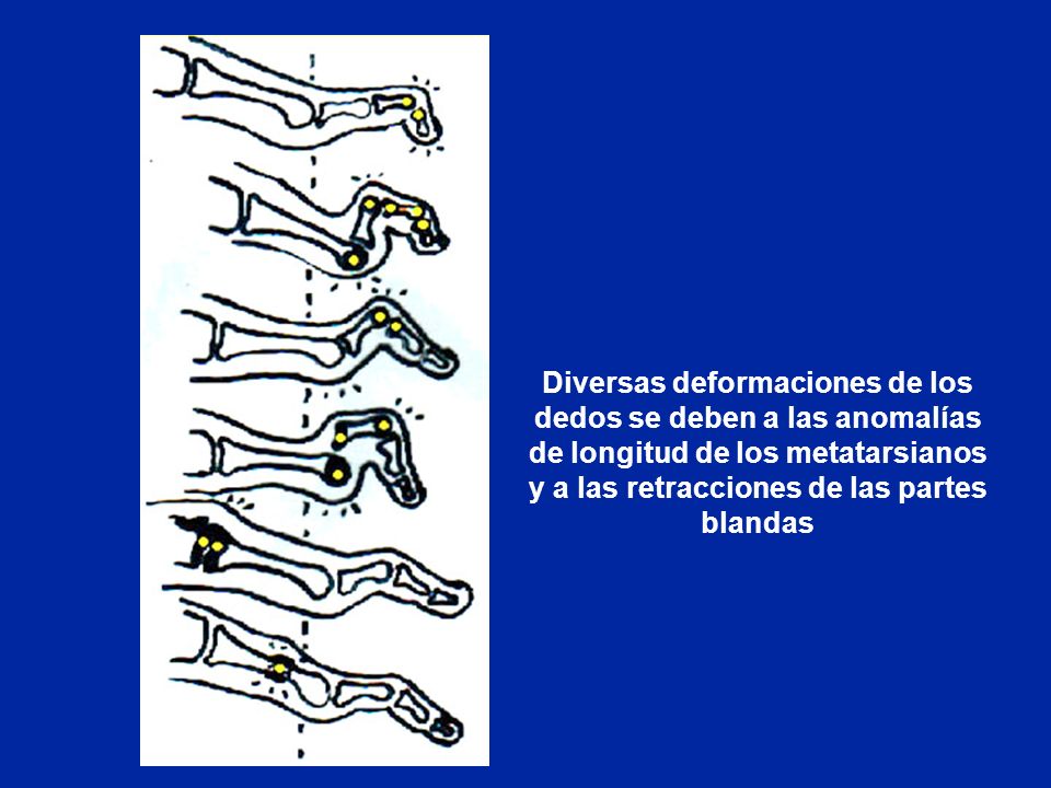 Diversas deformaciones de los dedos se deben a las anomalías de longitud de los metatarsianos y a las retracciones de las partes blandas