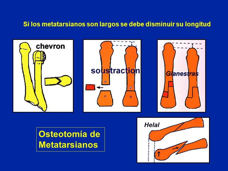 Si los metatarsianos son largos se debe disminuir su longitud