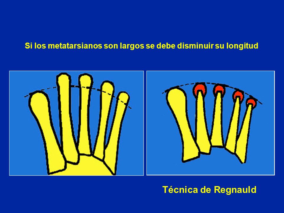 Si los metatarsianos son largos se debe disminuir su longitud