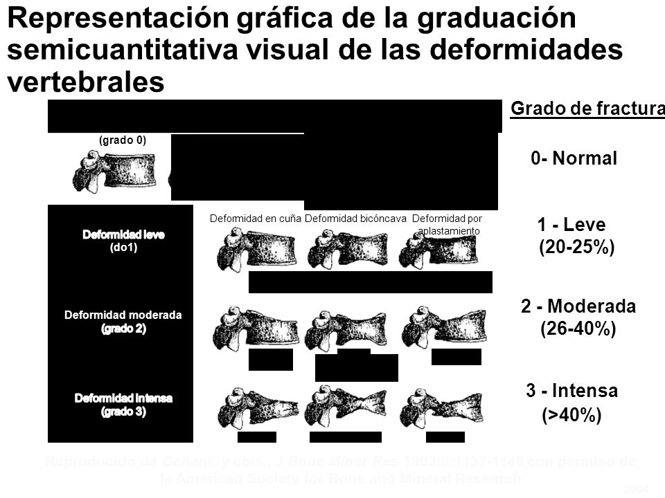 Representación gráfica de la graduación semicuantitativa visual de las deformidades vertebrales