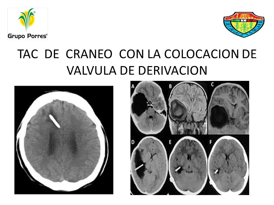 TAC DE CRANEO CON LA COLOCACION DE VALVULA DE DERIVACION