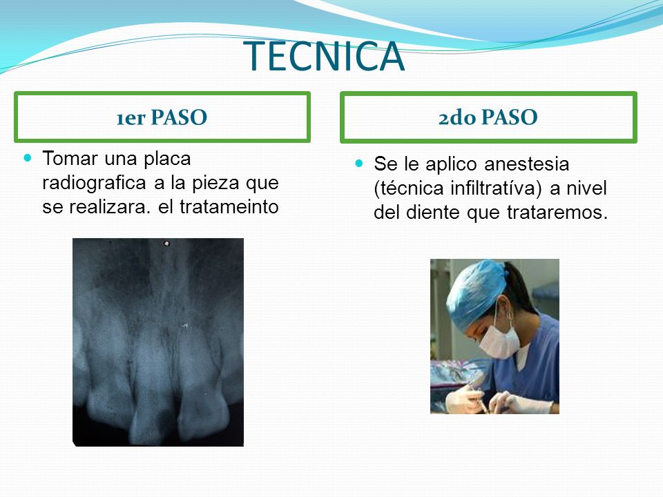 TECNICA 1er PASO. 2do PASO. Tomar una placa radiografica a la pieza que se realizara. el tratameinto.