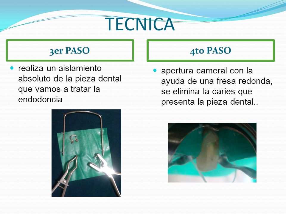 TECNICA 3er PASO. 4to PASO. realiza un aislamiento absoluto de la pieza dental que vamos a tratar la endodoncia.
