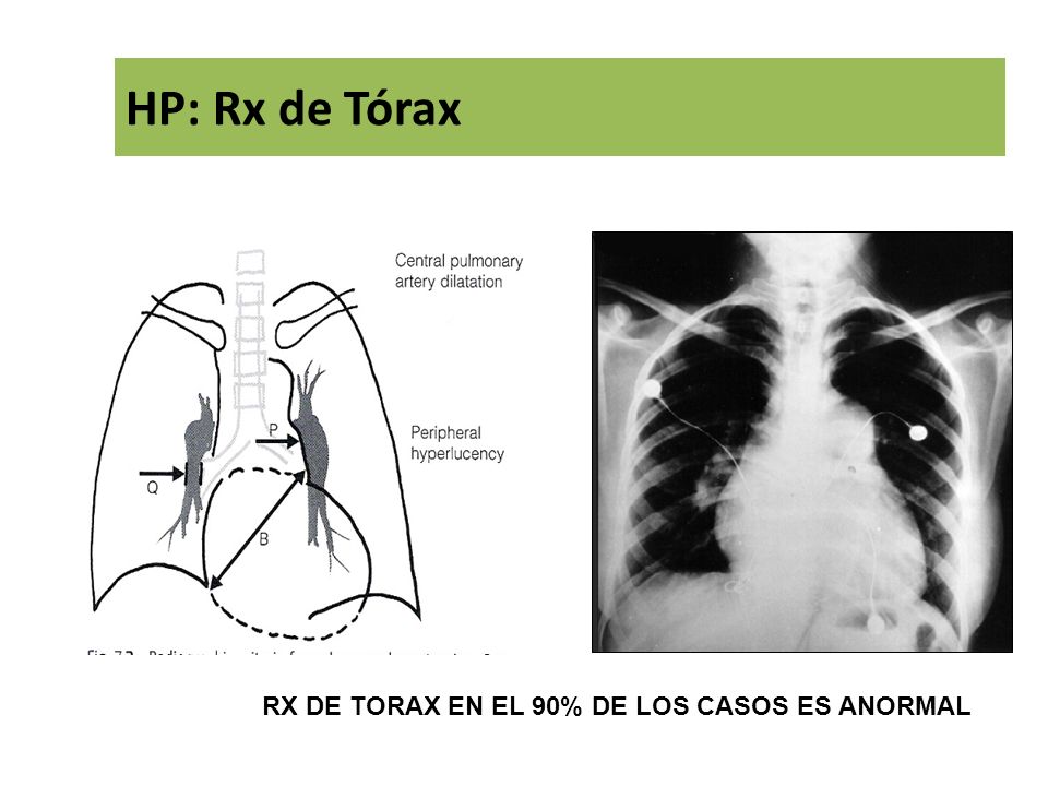 HP: Rx de Tórax RX DE TORAX EN EL 90% DE LOS CASOS ES ANORMAL 12