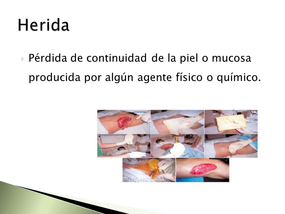 Herida Pérdida de continuidad de la piel o mucosa producida por algún agente físico o químico.